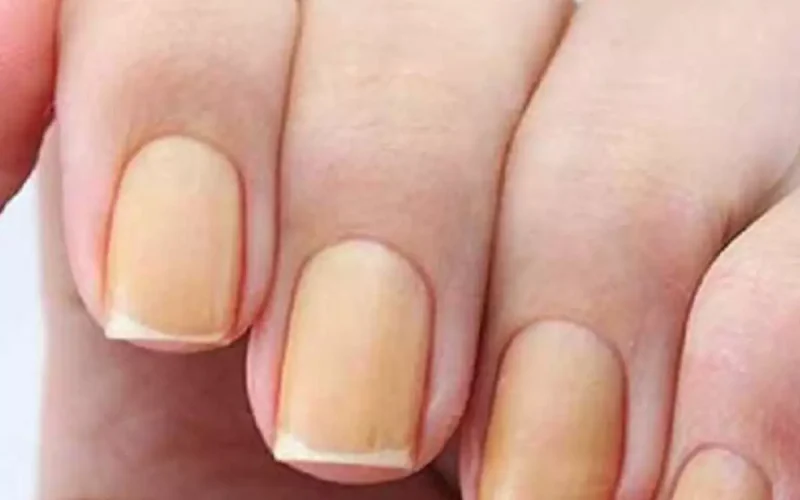 Nails and Health: Discover What Your Nails Can Reveal About Your Well-Being.